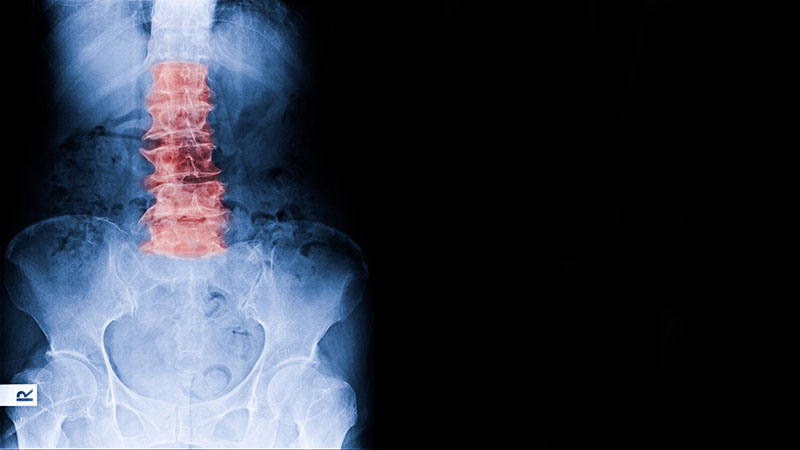 Spondylose Röntgenbild Spondylose Röntgenbild